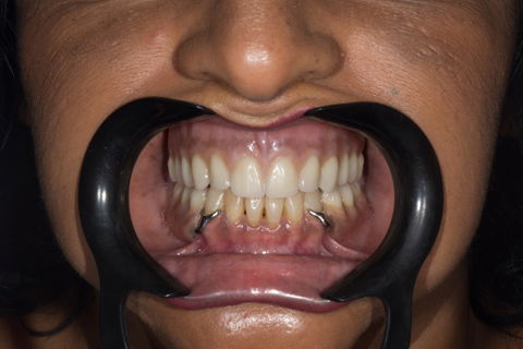 Prova das próteses finalizadas.