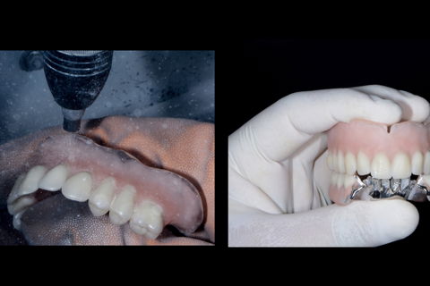 Preparo das próteses para receber a resina Pala cre-active (Kulzer- Alemanha) com asperização por jateamento com Al2O3, e limpeza das mesmas.