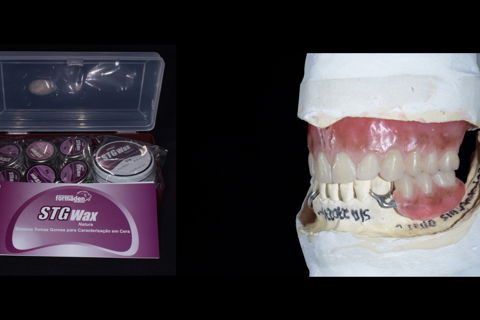 Prótese total e Prótese parcial removível com enceramento gengival caracterizado, pronto para prova dos dentes, e análise da cor e característica gengival.