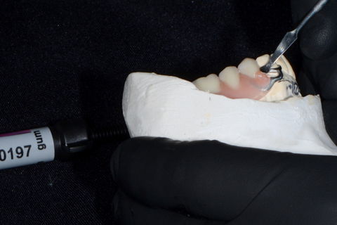 Aplicação da primeira camada do sistema Pala cre-active (Kulzer- Alemanha), na base da resina acrílica.