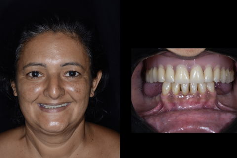 Aspecto inicial da prótese antiga.