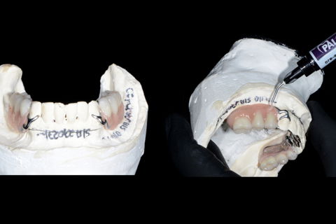 Definição dos contornos e começo da escultura gengival.