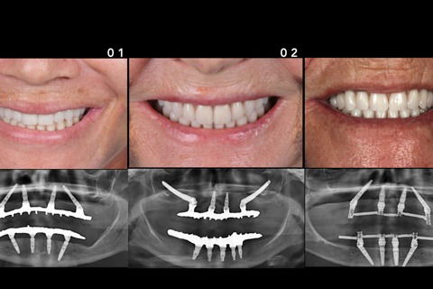 Resultado final imediato dos 3 casos clínicos