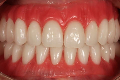 Etapa 1 - Moldagem inicial para registro e montagem dos dentes. Etapa 2 - Prova estética pré-operatória intra-oral