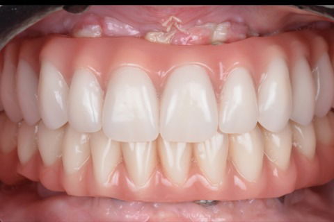 Instalação da prótese do tipo protocolo após 3 dias