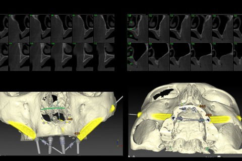Avaliação dos exames tomográficos, planejamento e cirurgia virtual