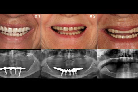 O planejamento inicial através da avaliação sistêmica do paciente e análise extra e intra-oral.