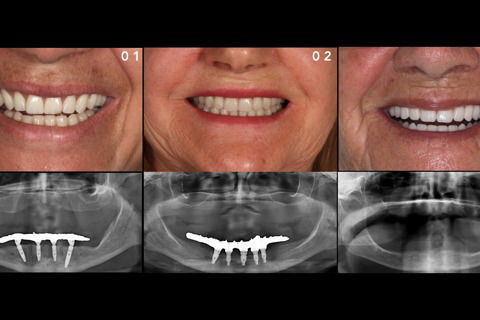 Prova estética pré-operatória extra-oral