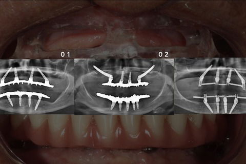 Técnica All-on-4: Caso 1 e 3 implantes inclinados, Caso 2: Associado ao implante zigomático
