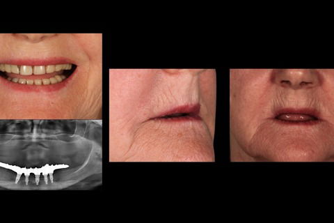 Avaliação do suporte de labial