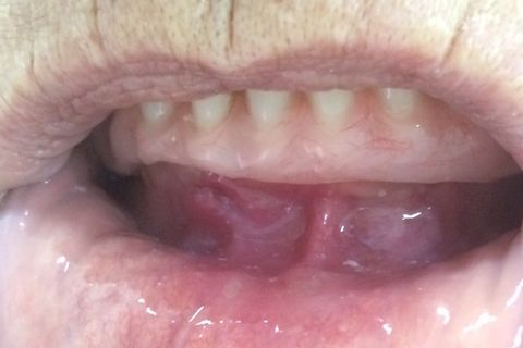 Alivio da dor, melhora do caso em 2 dias