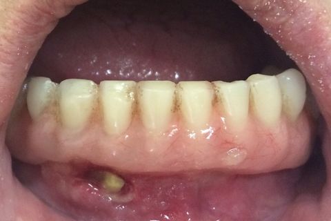 Protese ajustada e parafusada