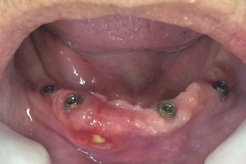 Ferida de Trauma com Protocolo Inferior, Base Anti-Higiênica Somado à Tabagismo