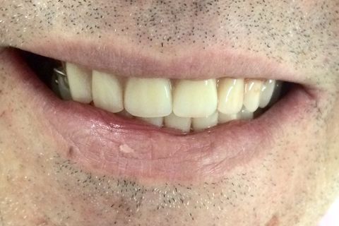 Aspecto final com as provisórias