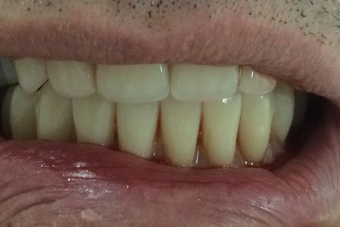 Protese Total Imediata para Futuros Protocolos