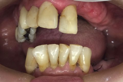 Protese Total Imediata para Futuros Protocolos