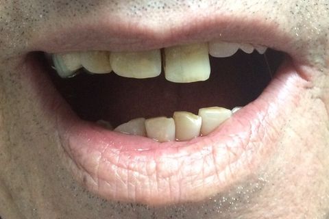 Desnível da PPR pela extrusão