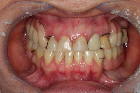 Oclusão PPR´s Provisórias