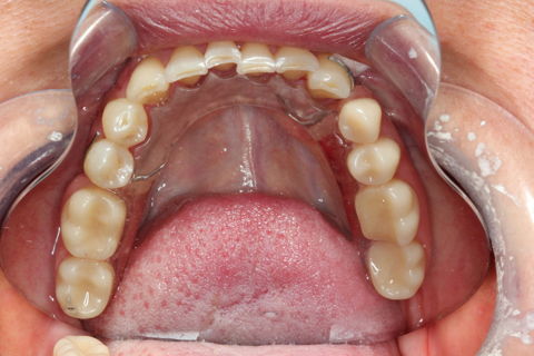 PPR Provisória Inferior