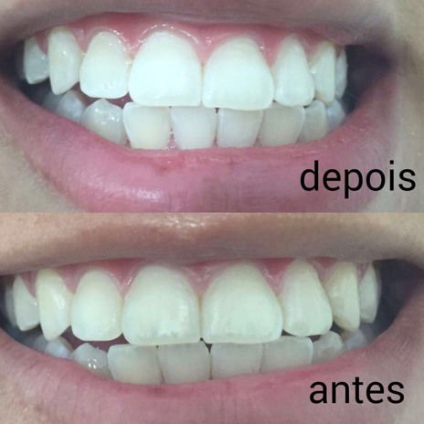Clareamento Dental Mediato