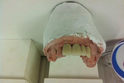 Aplicação da cerâmica após prova do metal