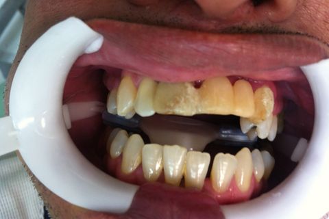 Reabilitação Prótese Fixa 4 Elementos Porcelana