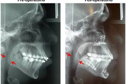 Pós-operatório onde observamos rotação anti-horária do plano oclusal com avanço de mandíbula e mento mais reposicionamento superior de maxila. Note entre as setas o aumento das vias aéreas, o que favorece a diminuição de roncos e episódios de apneia durante o sono.