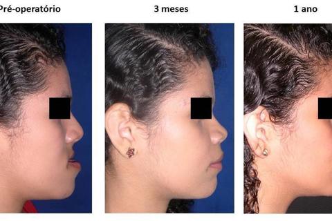 Perfil mostrando harmonia facial e um preenchimento natural da região para-nasal devido ao avanço de maxila no pós-operatório de 3 meses e 1 ano.