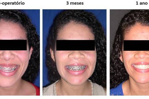 Norma frontal no sorriso com 3 meses e 1 ano.