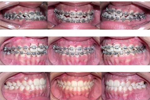 Acima: Oclusão no pré-operatório. No centro: Pós-operatório de 3 meses. Abaixo: Pós-operatório de 1 anos após finalização do tratamento ortodôntico.